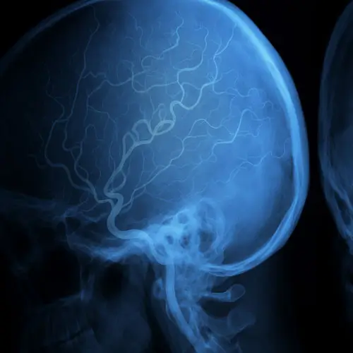 neurorradiologista intervencionista