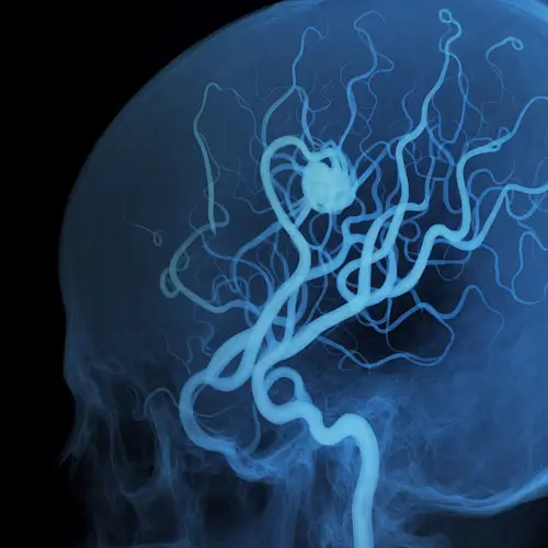 neurorradiologista intervencionista