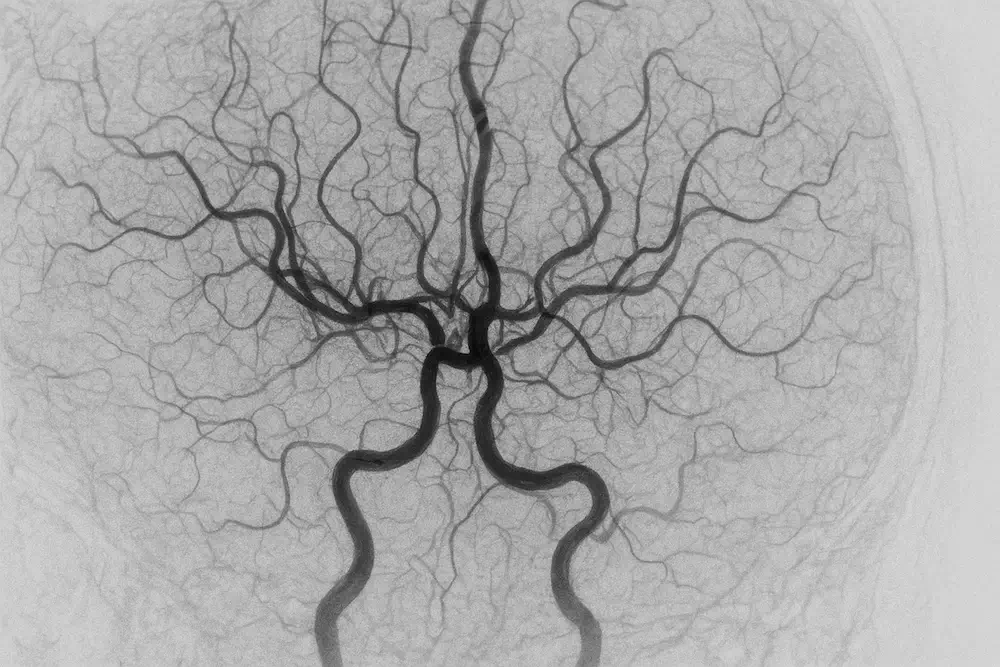 neurorradiologista intervencionista